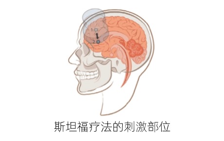 高質(zhì)量文獻：多療程斯坦福療法（SNT）對重度抑郁癥復發(fā)后療效驗證